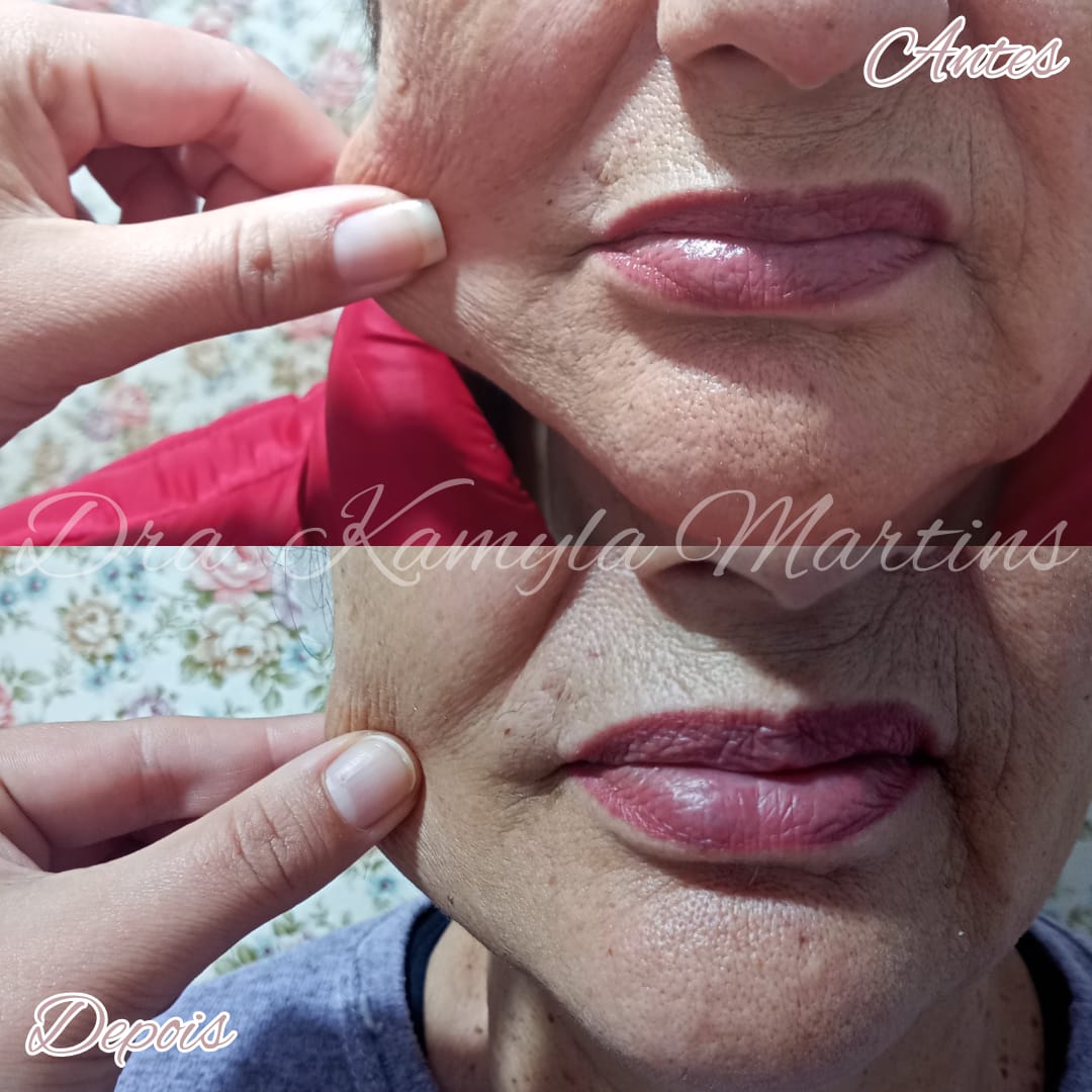 Antes e depois — Bioestimulador de colágeno
