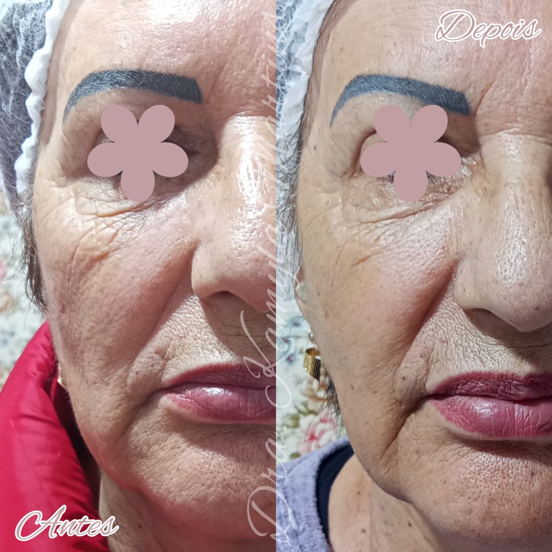 Antes e depois — Bioestimulador de colágeno