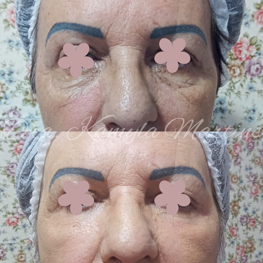Antes e depois — Blefaroplastia química