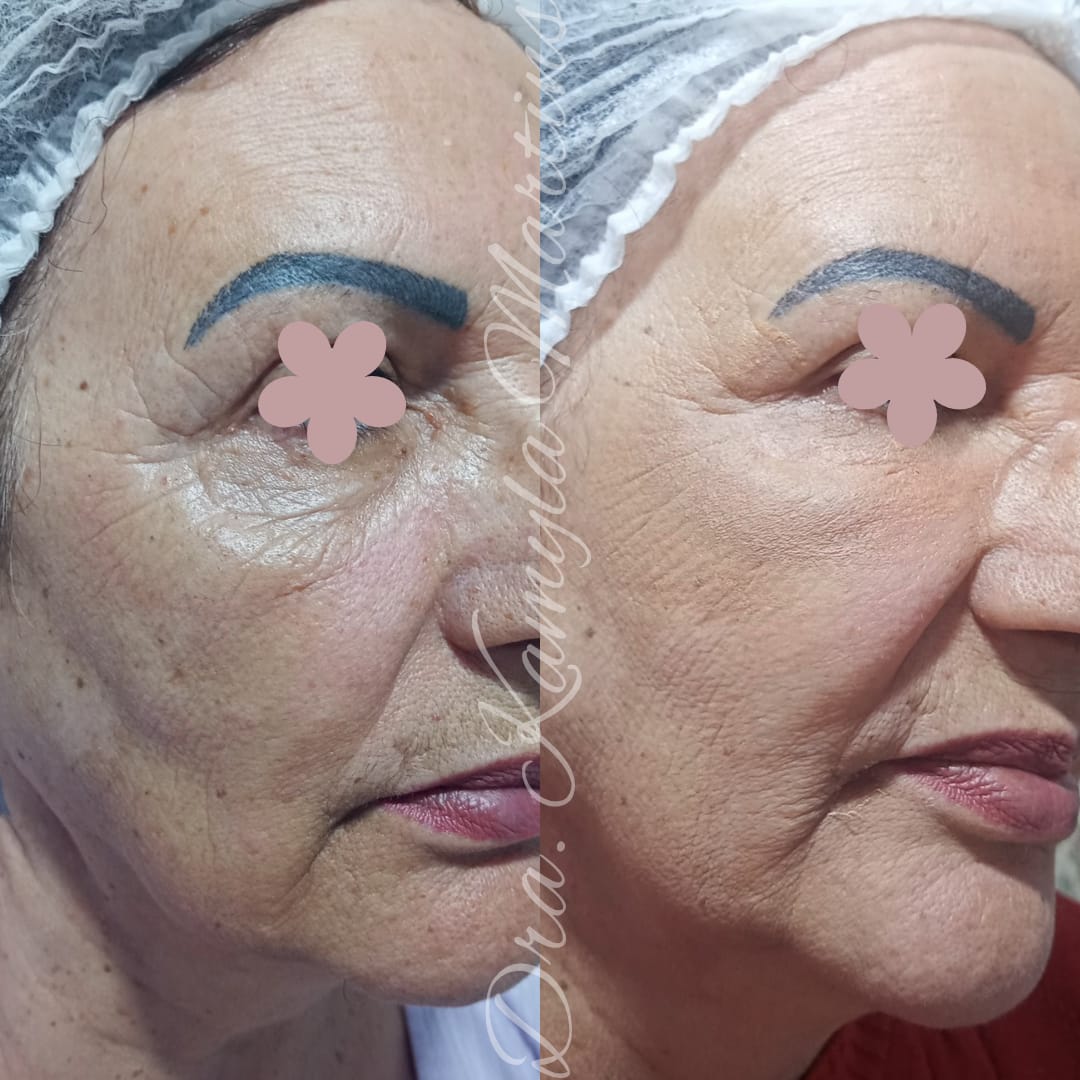 Antes e depois — Blefaroplastia química