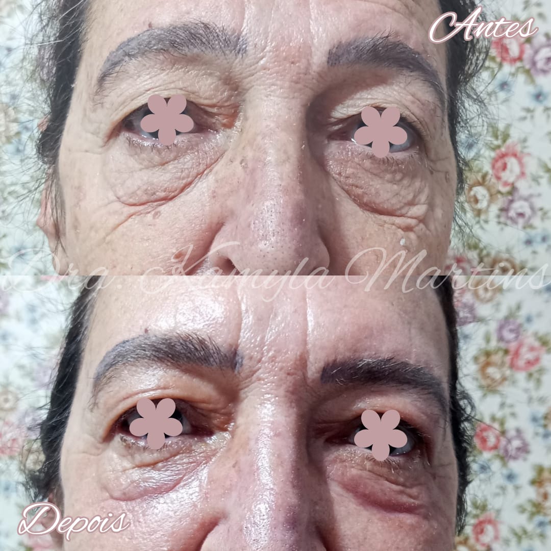 Antes e depois — Blefaroplastia química
