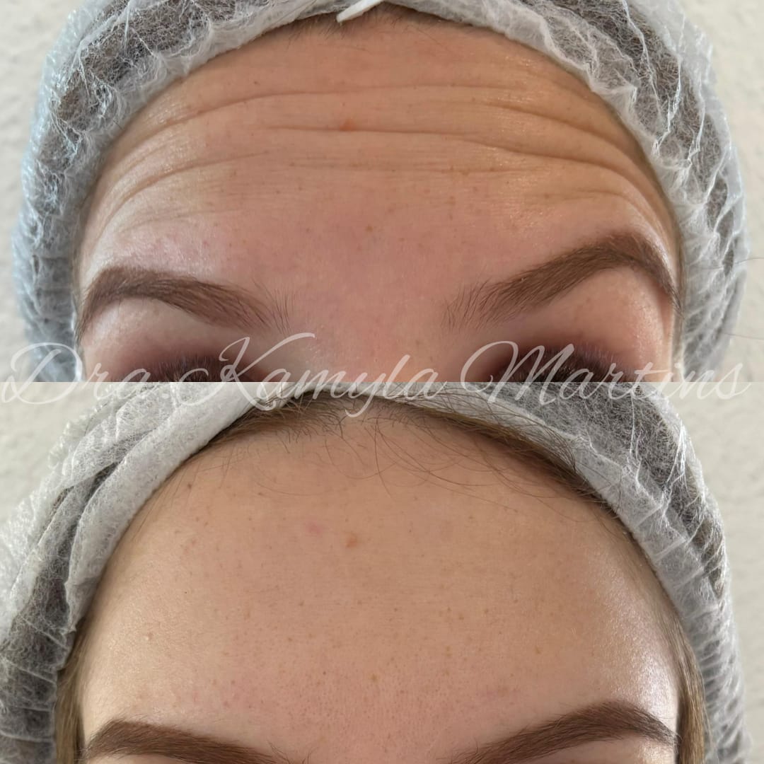 Antes e depois — Botox