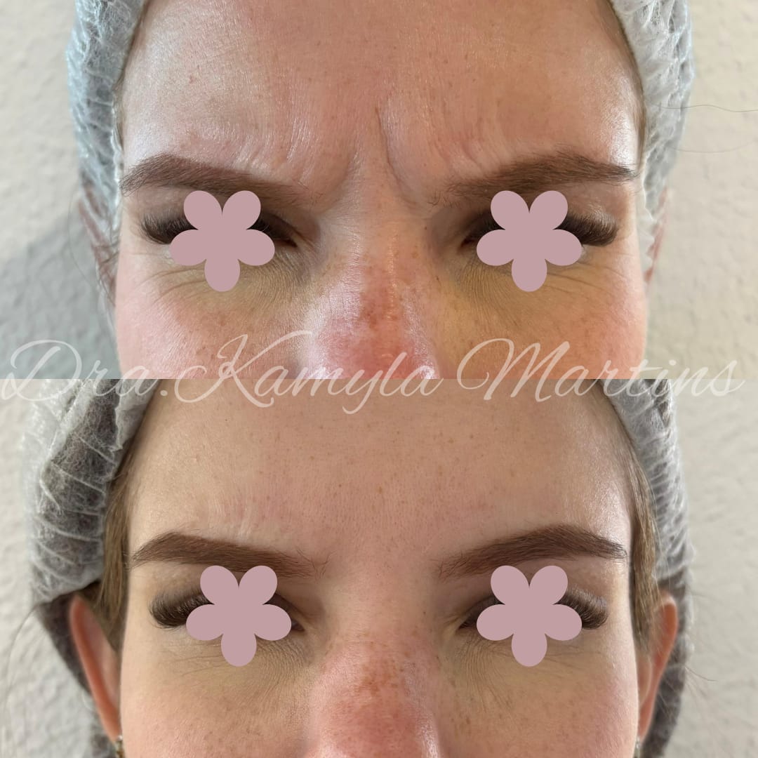 Antes e depois — Botox