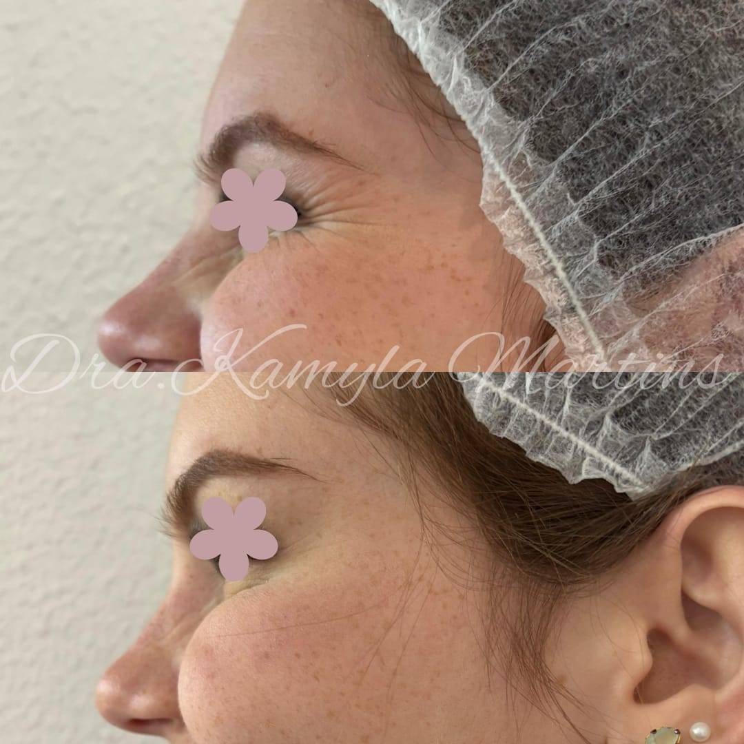 Antes e depois — Botox