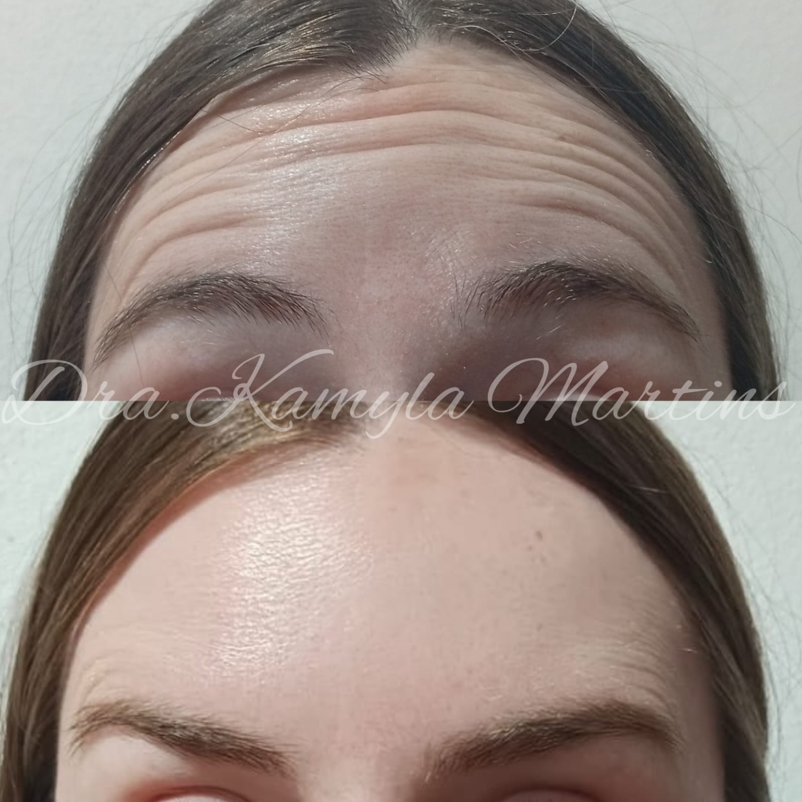 Antes e depois — Botox