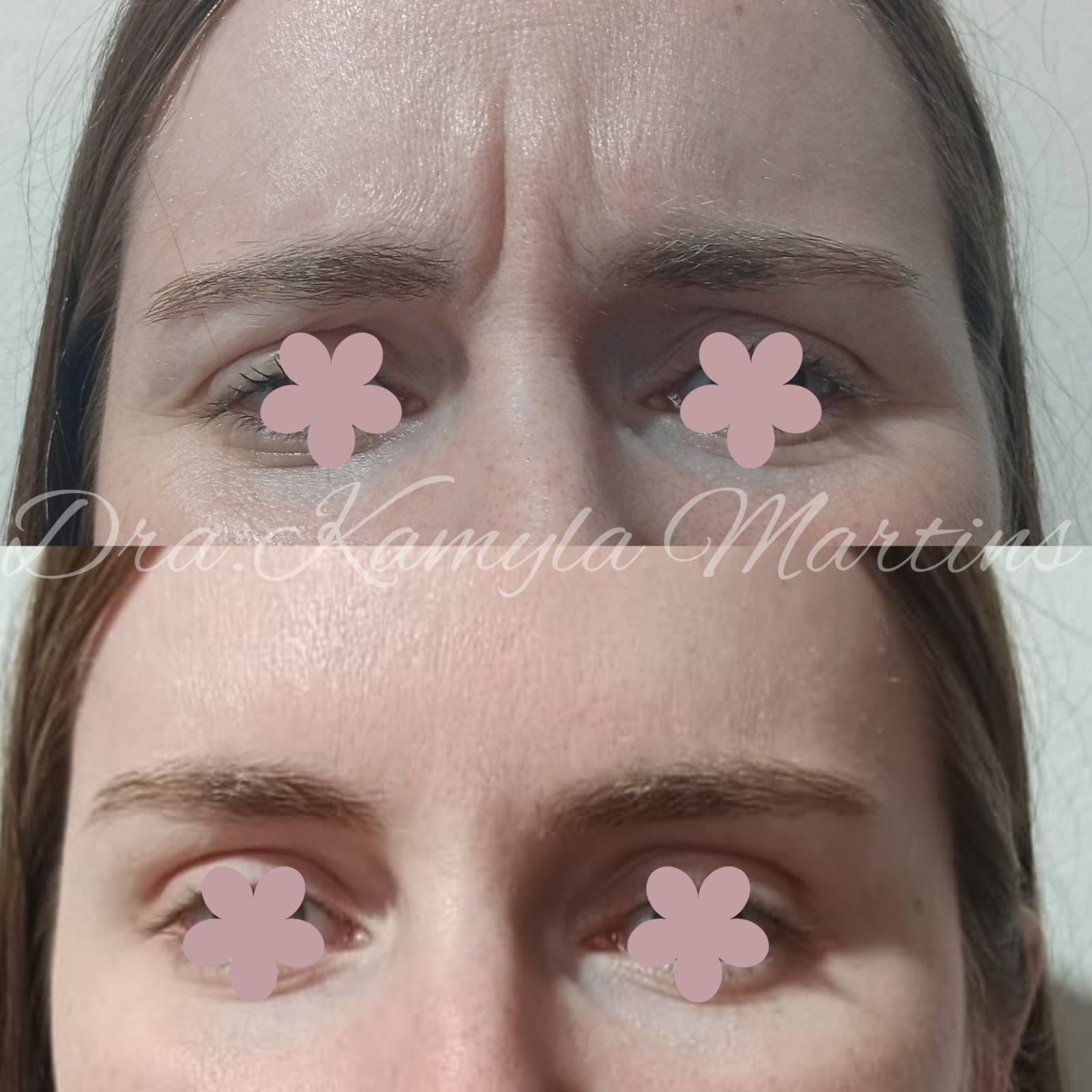 Antes e depois — Botox