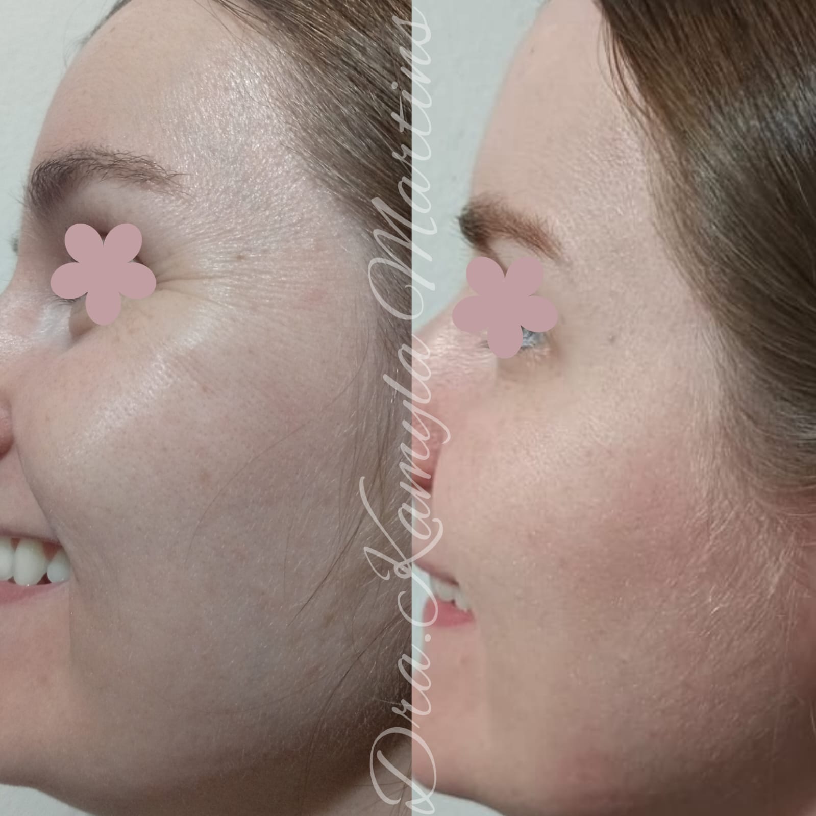 Antes e depois — Botox