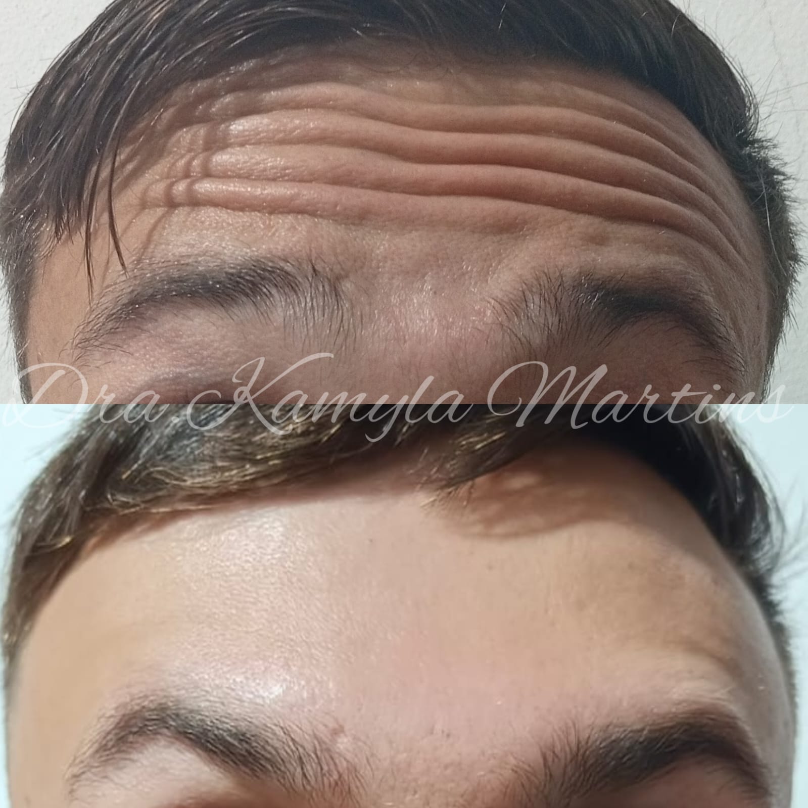 Antes e depois — Botox