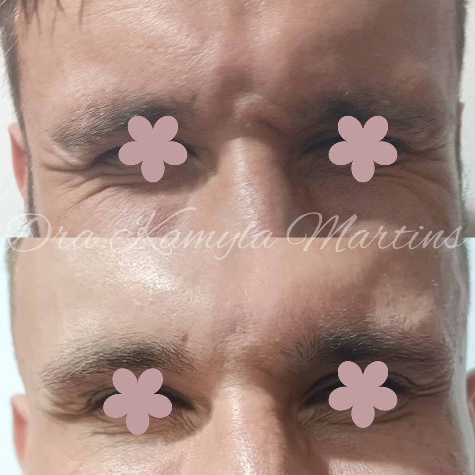 Antes e depois — Botox