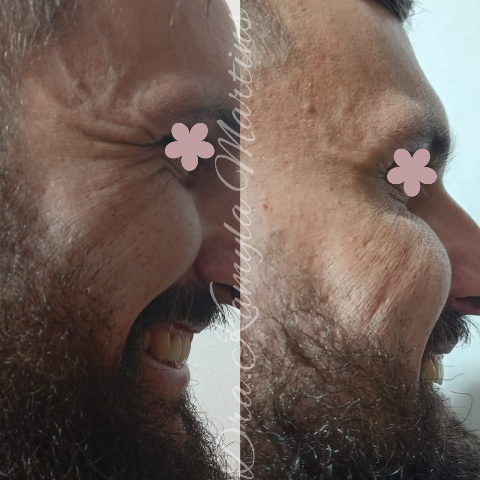 Antes e depois — Botox