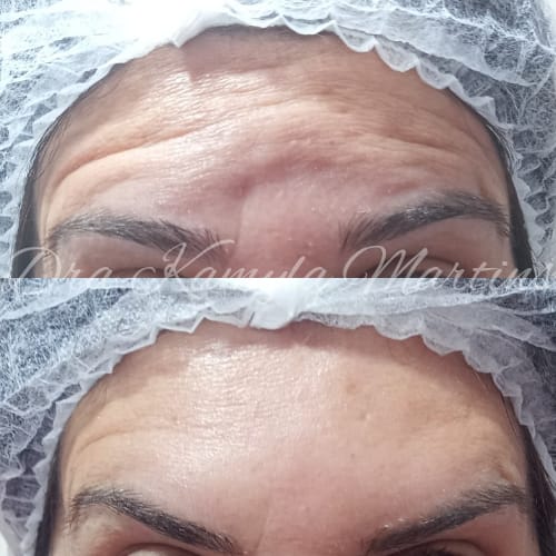 Antes e depois — Botox