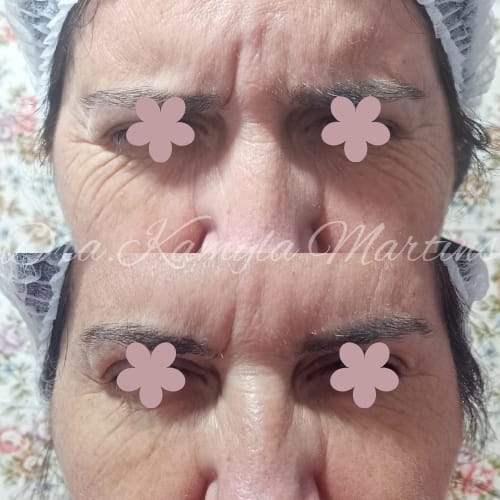 Antes e depois — Botox