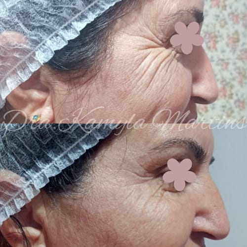 Antes e depois — Botox