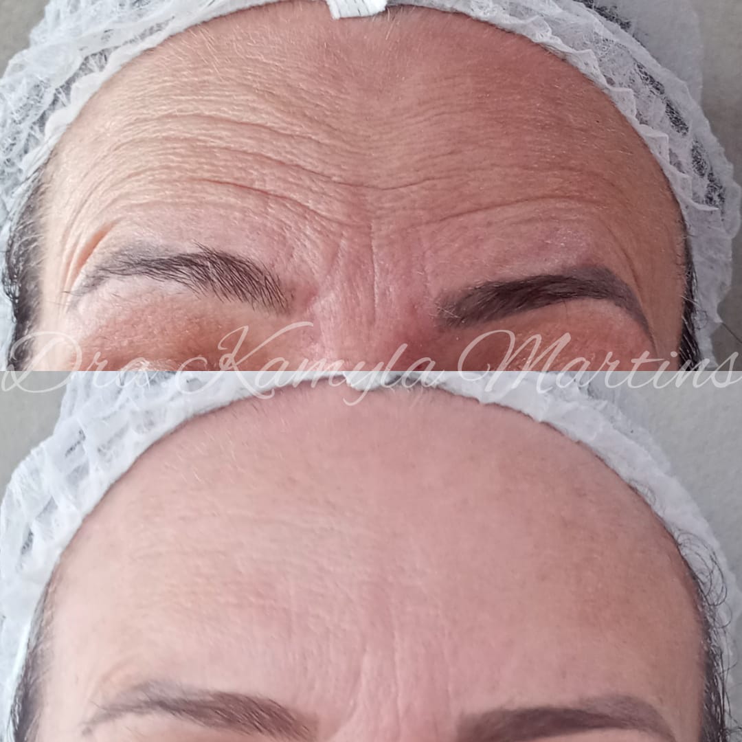 Antes e depois — Botox