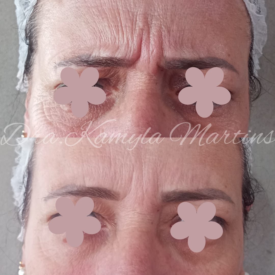 Antes e depois — Botox