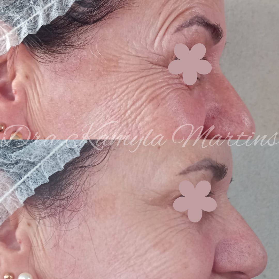 Antes e depois — Botox
