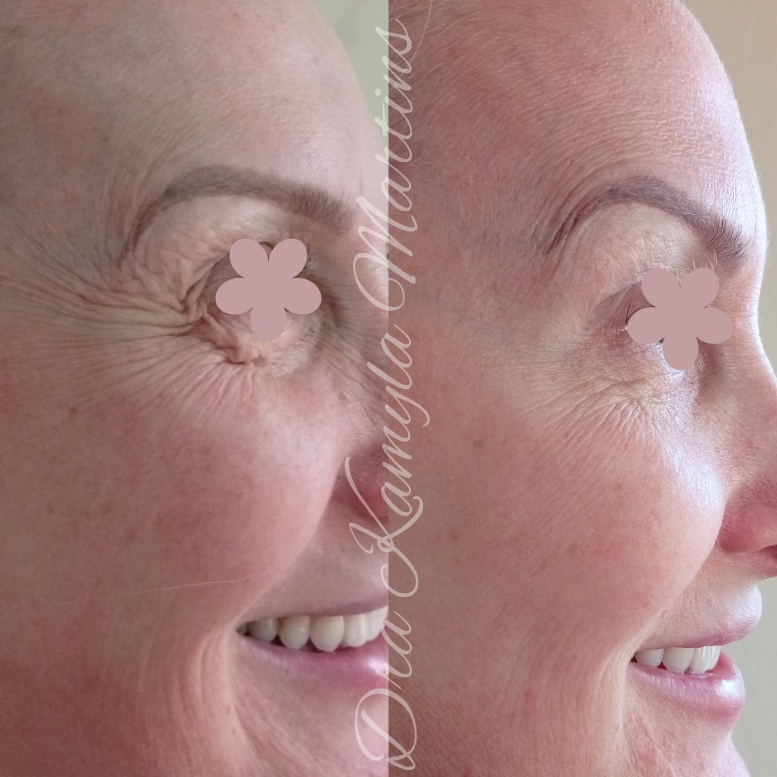 Antes e depois — Botox