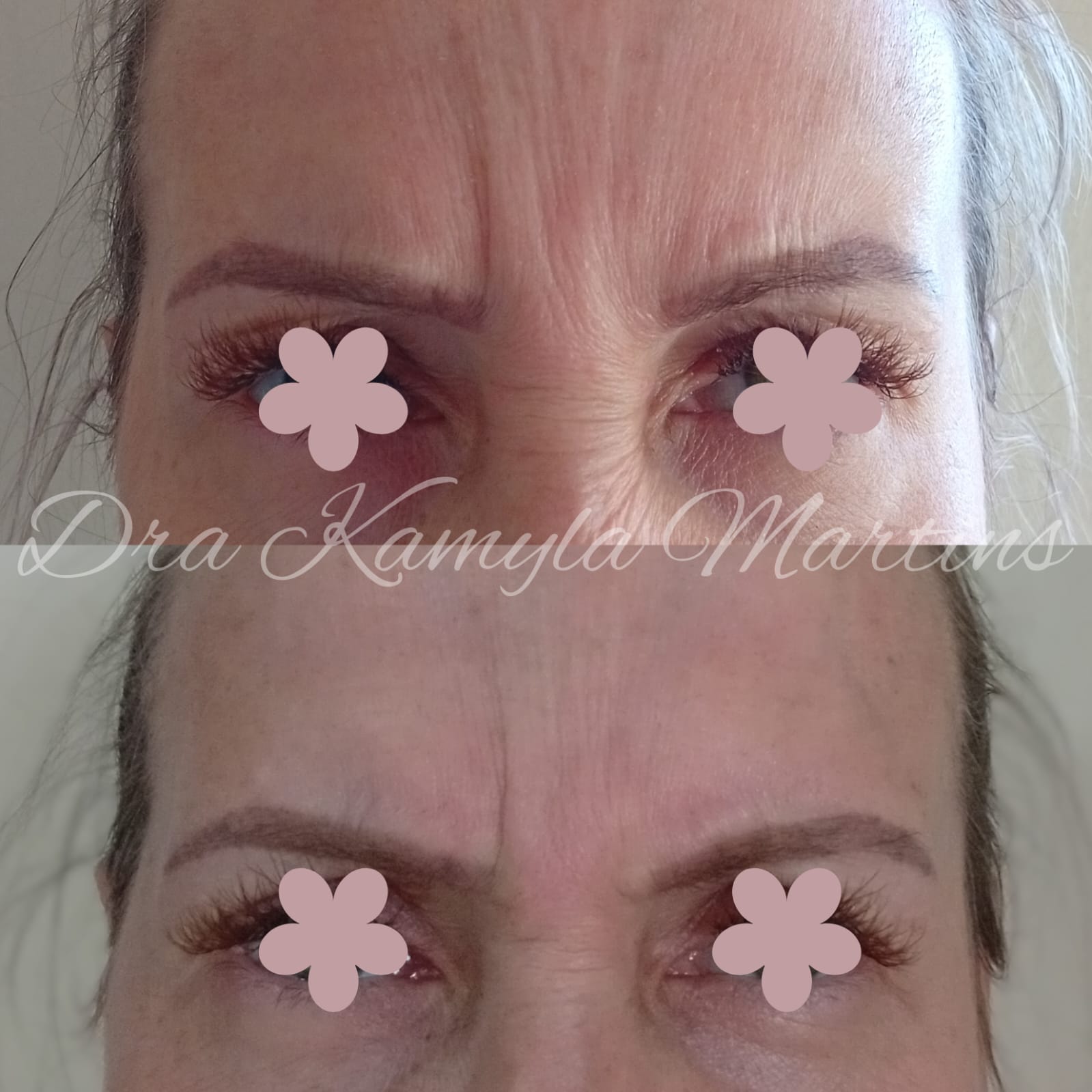 Antes e depois — Botox
