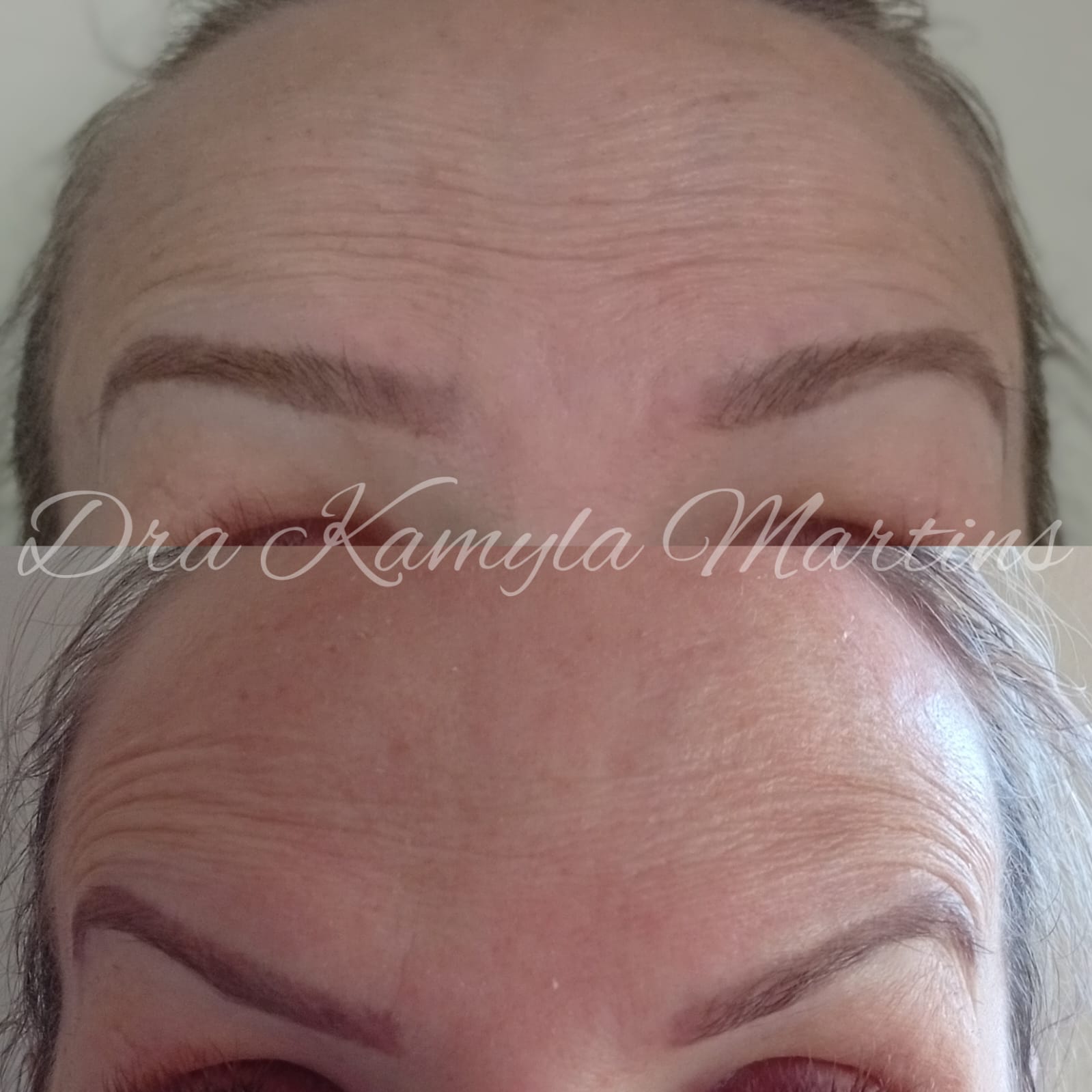 Antes e depois — Botox