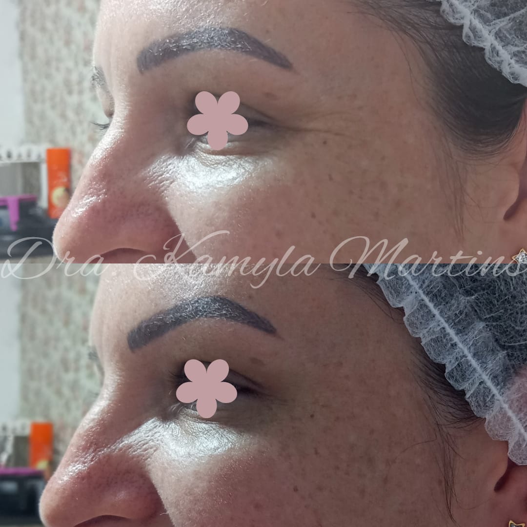 Antes e depois — Botox