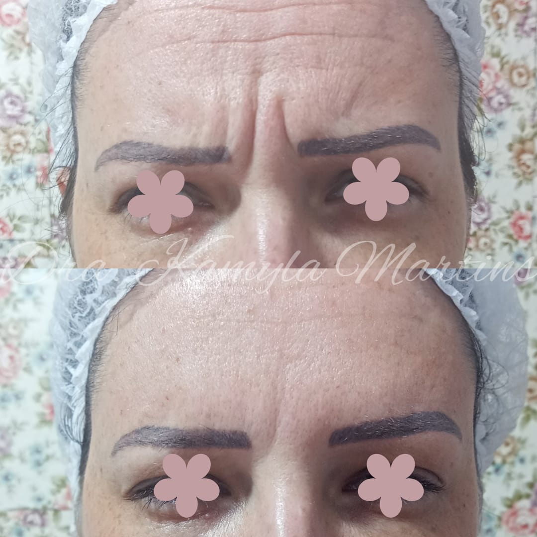Antes e depois — Botox