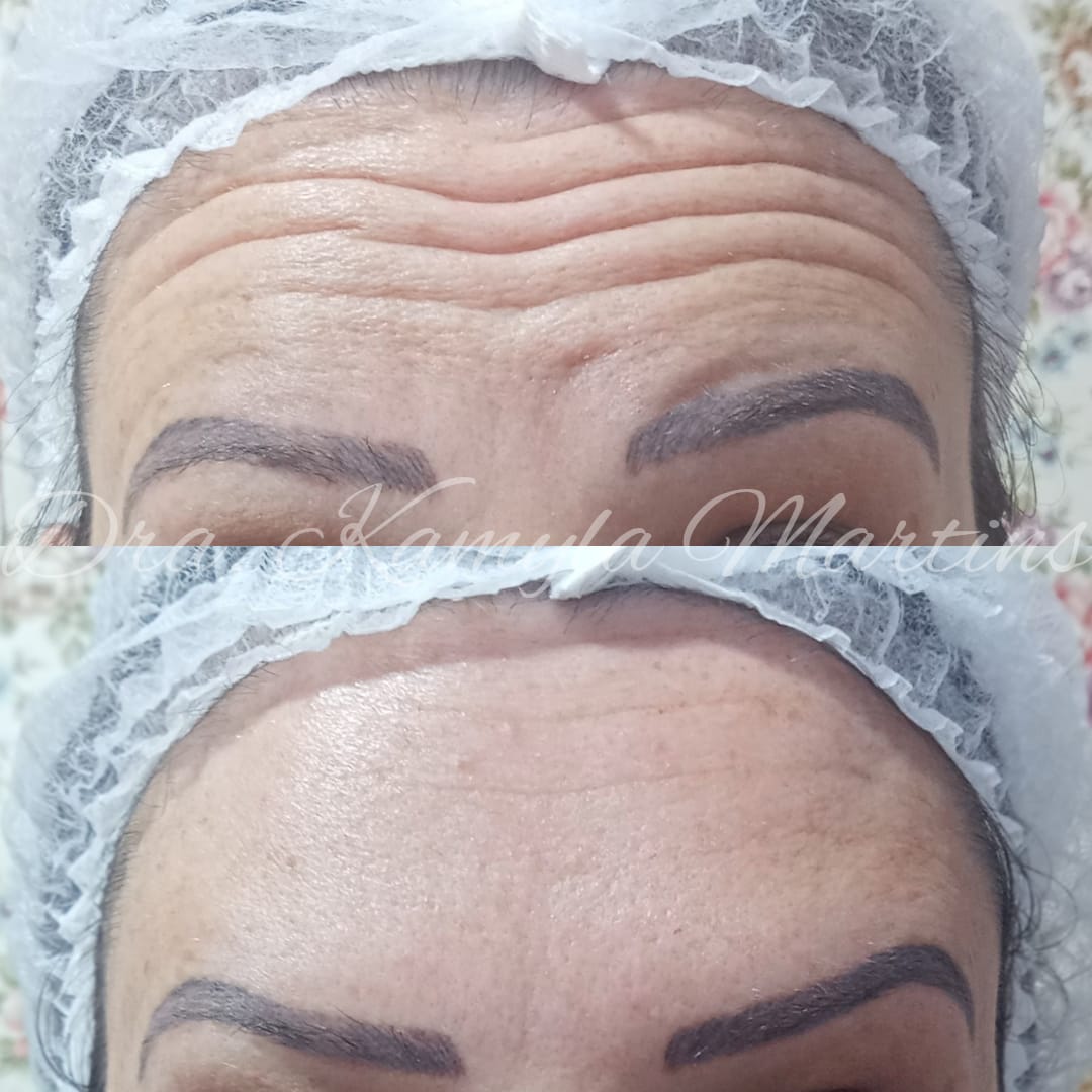 Antes e depois — Botox