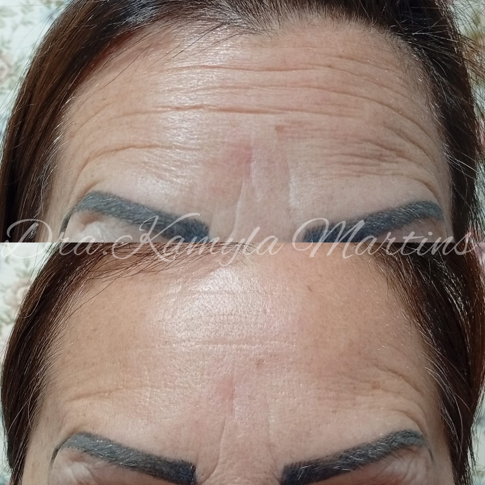 Antes e depois — Botox