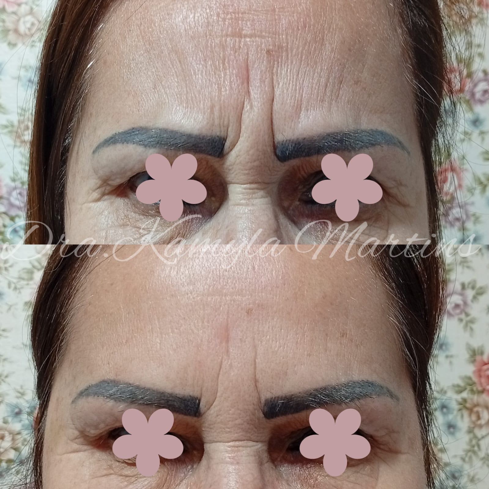 Antes e depois — Botox