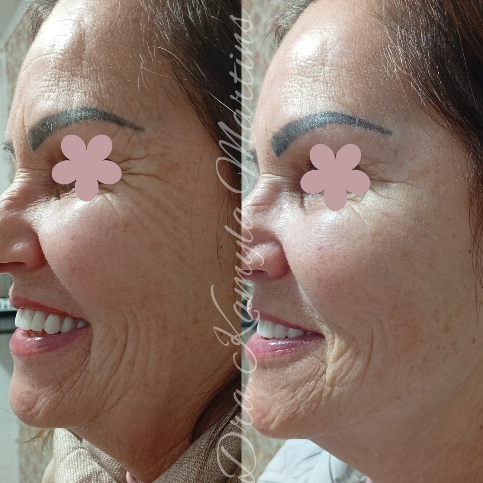 Antes e depois — Botox