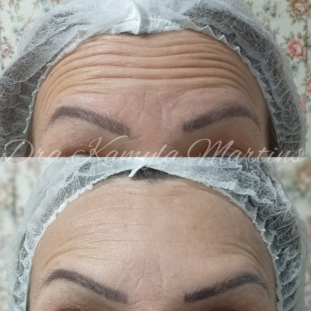 Antes e depois — Botox