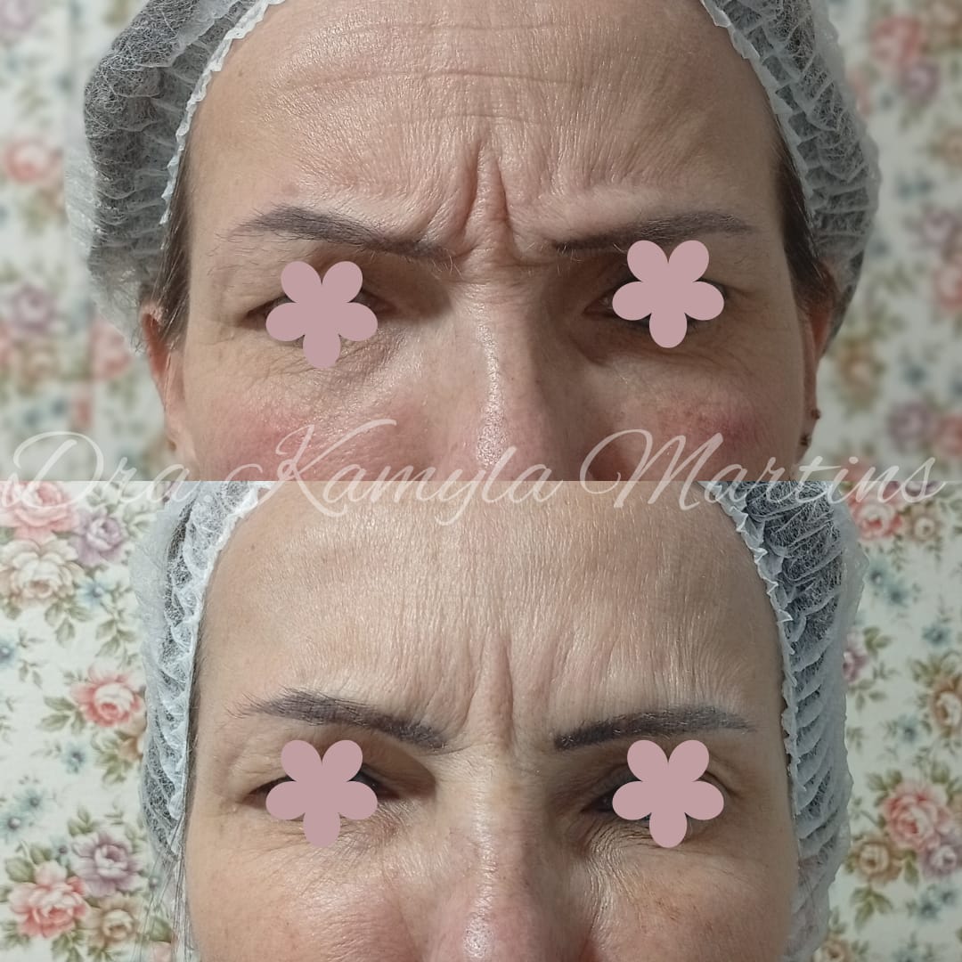 Antes e depois — Botox