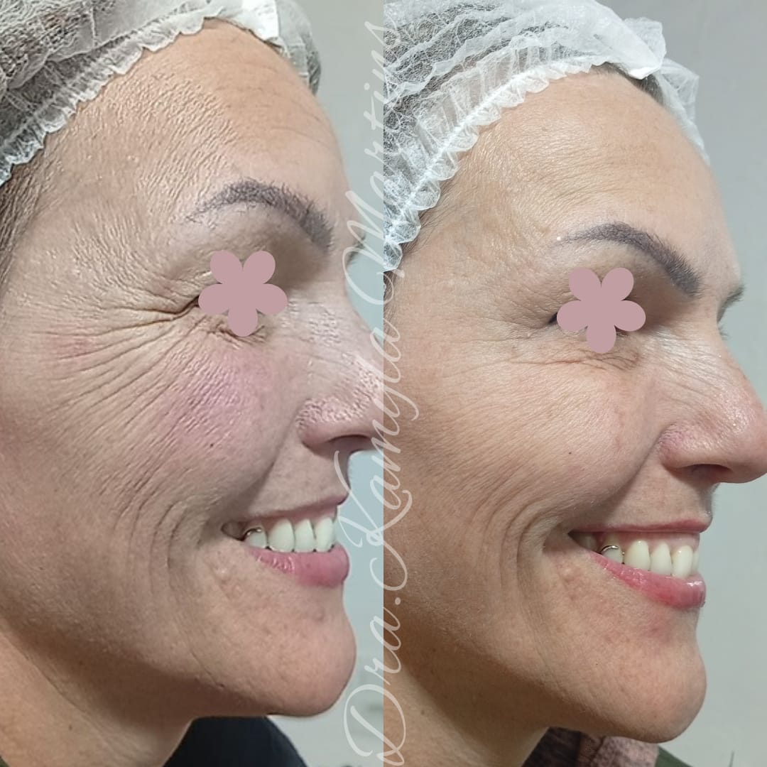 Antes e depois — Botox