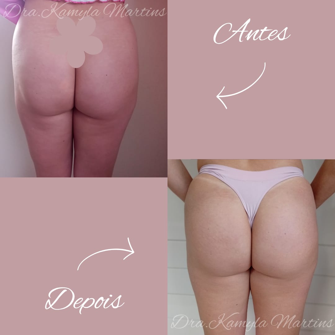 Harmonização de glúteos