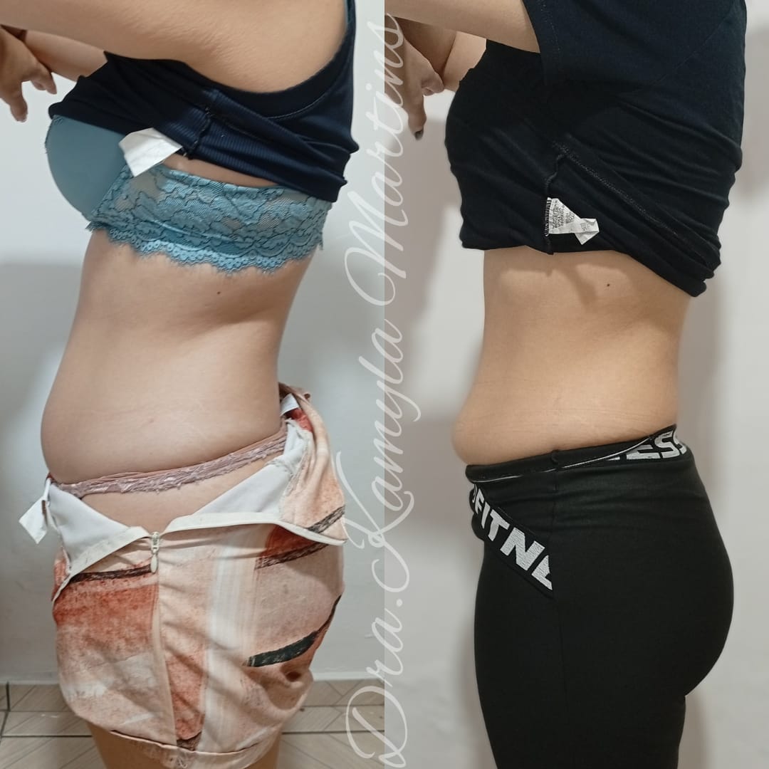 Antes e depois — Intradermoterapia