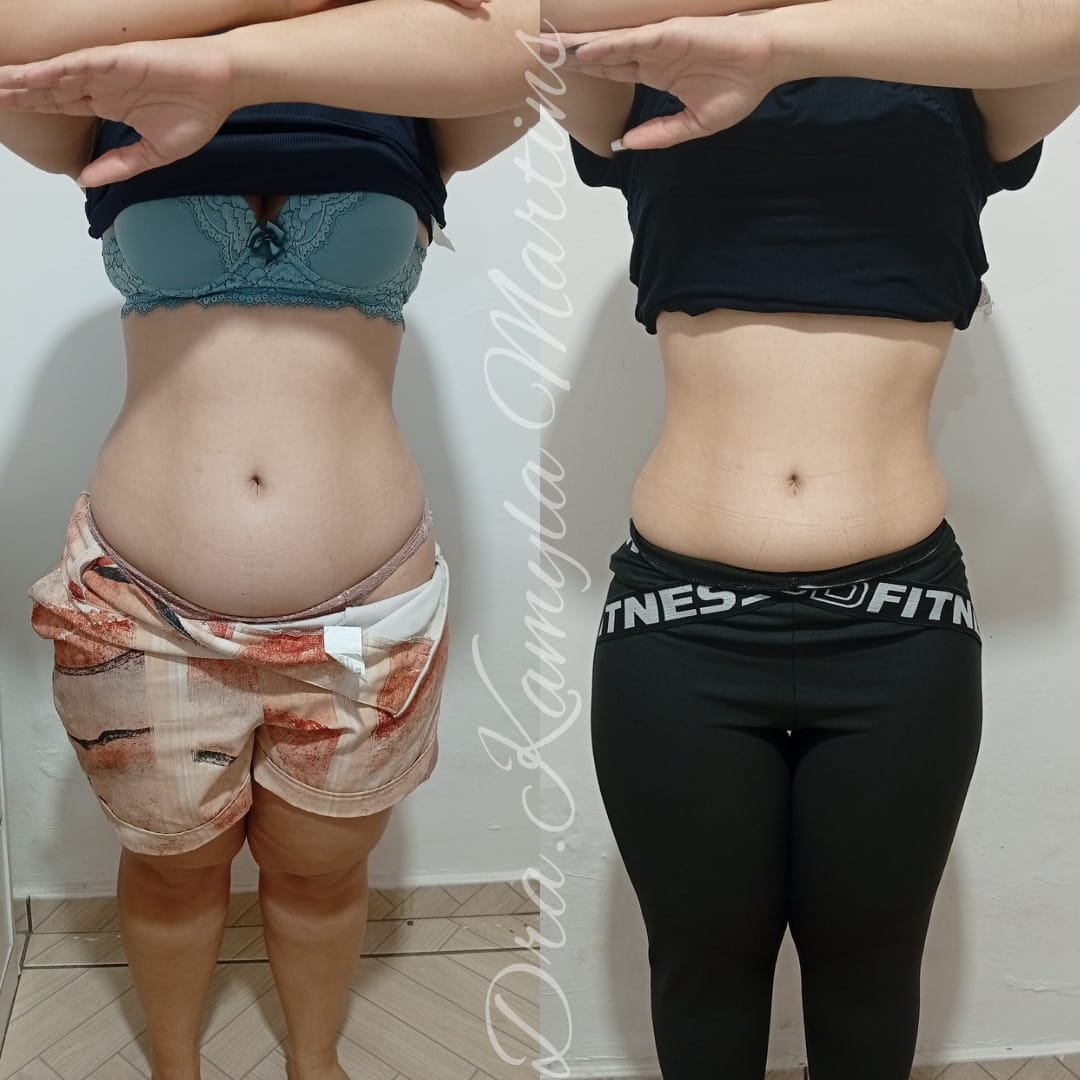 Antes e depois — Intradermoterapia