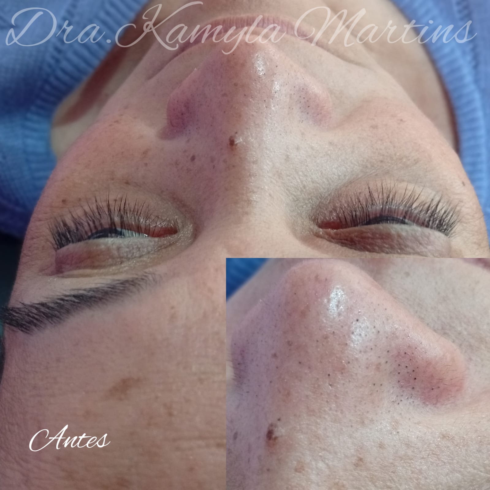 Antes e depois — Limpeza de pele
