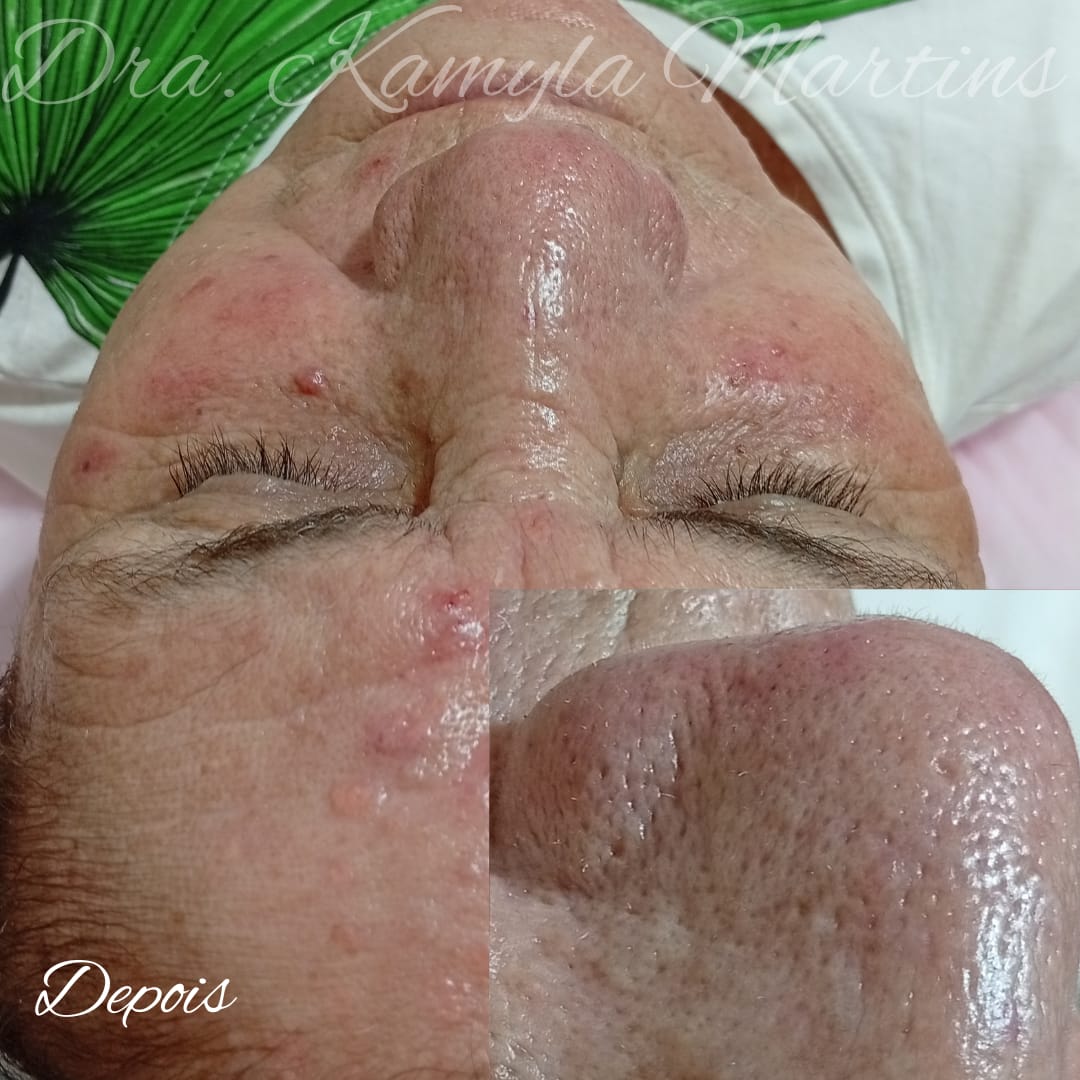 Antes e depois — Limpeza de pele