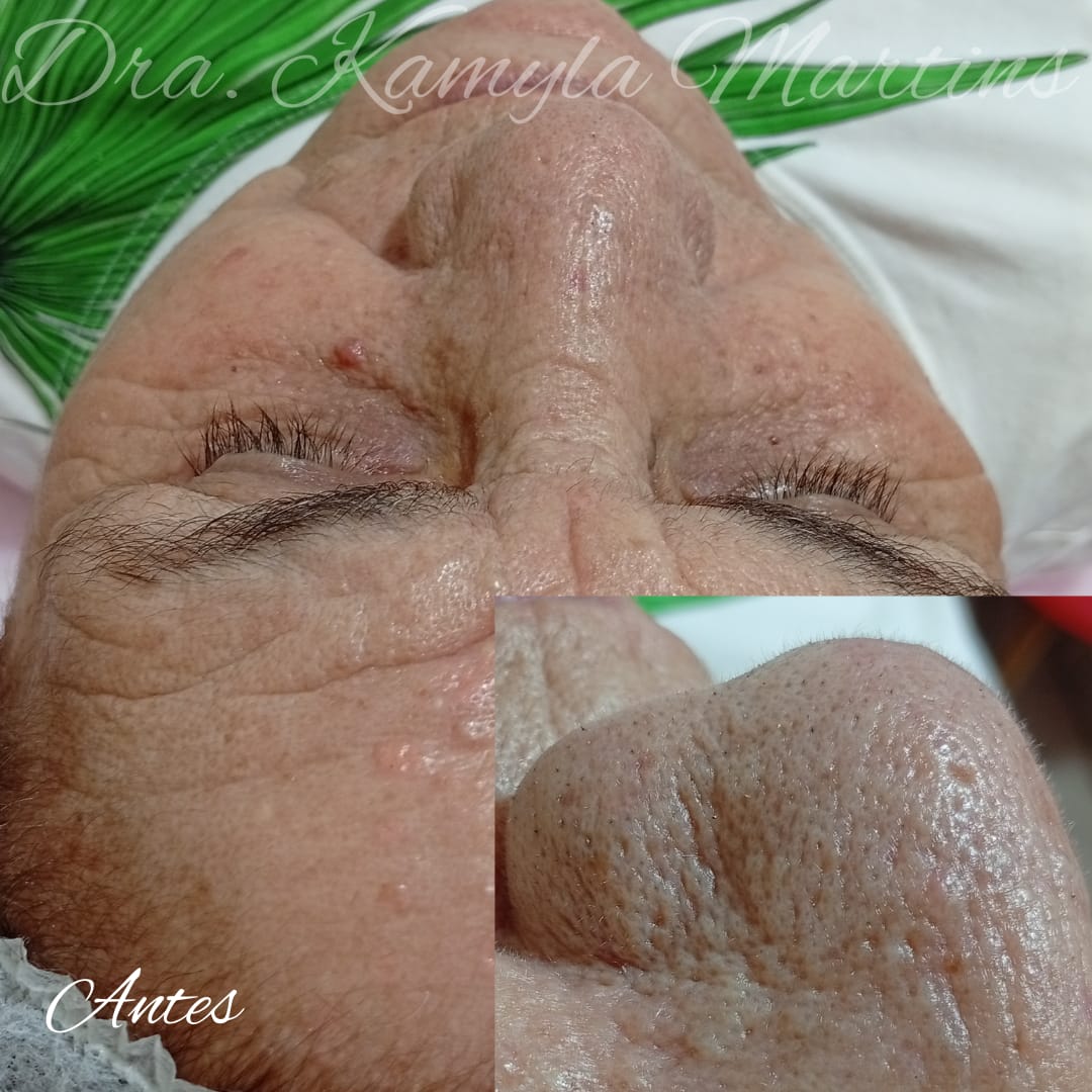 Antes e depois — Limpeza de pele