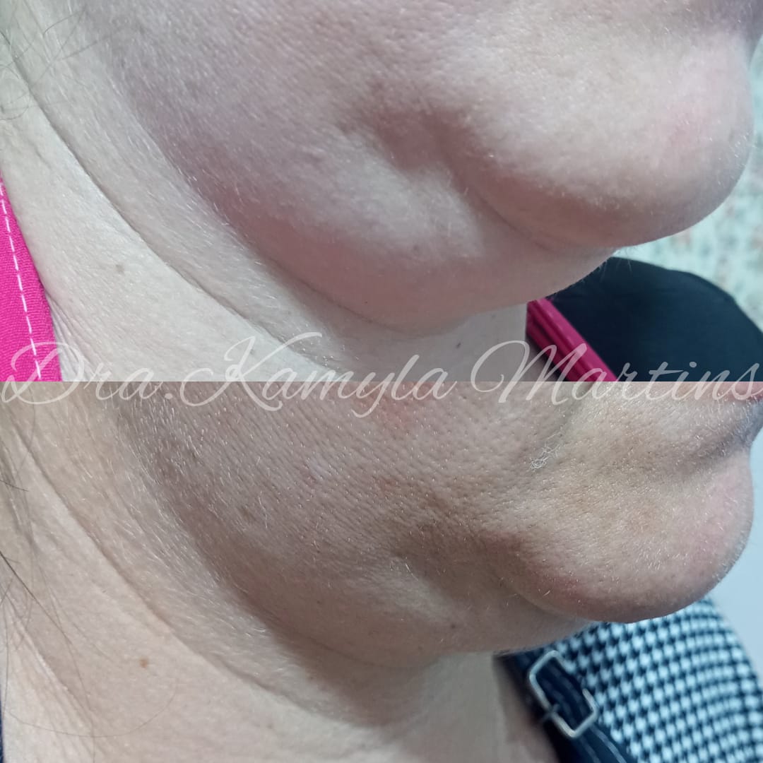 Antes e depois — Lipo de papada