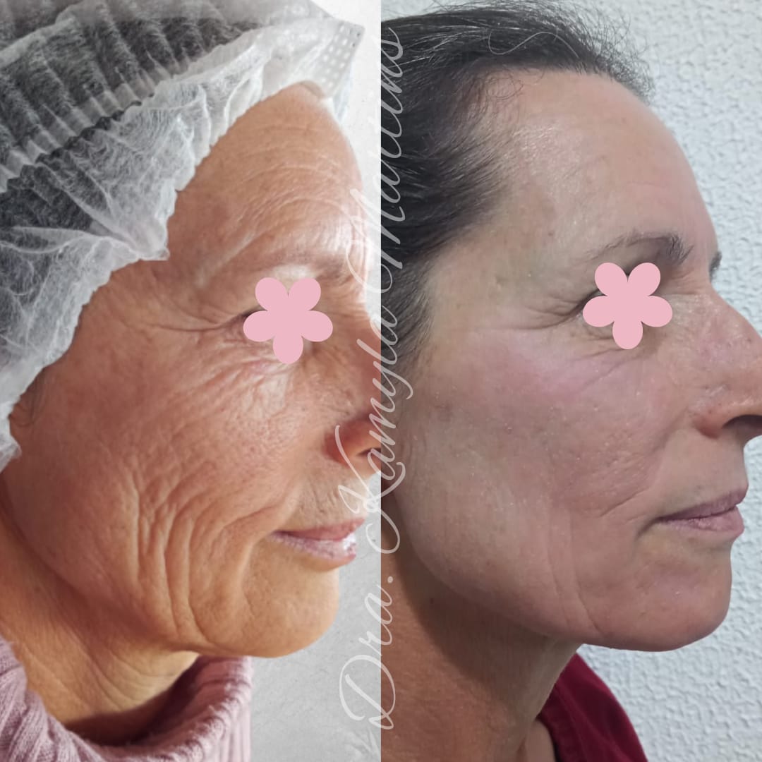Antes e depois — Peeling full face