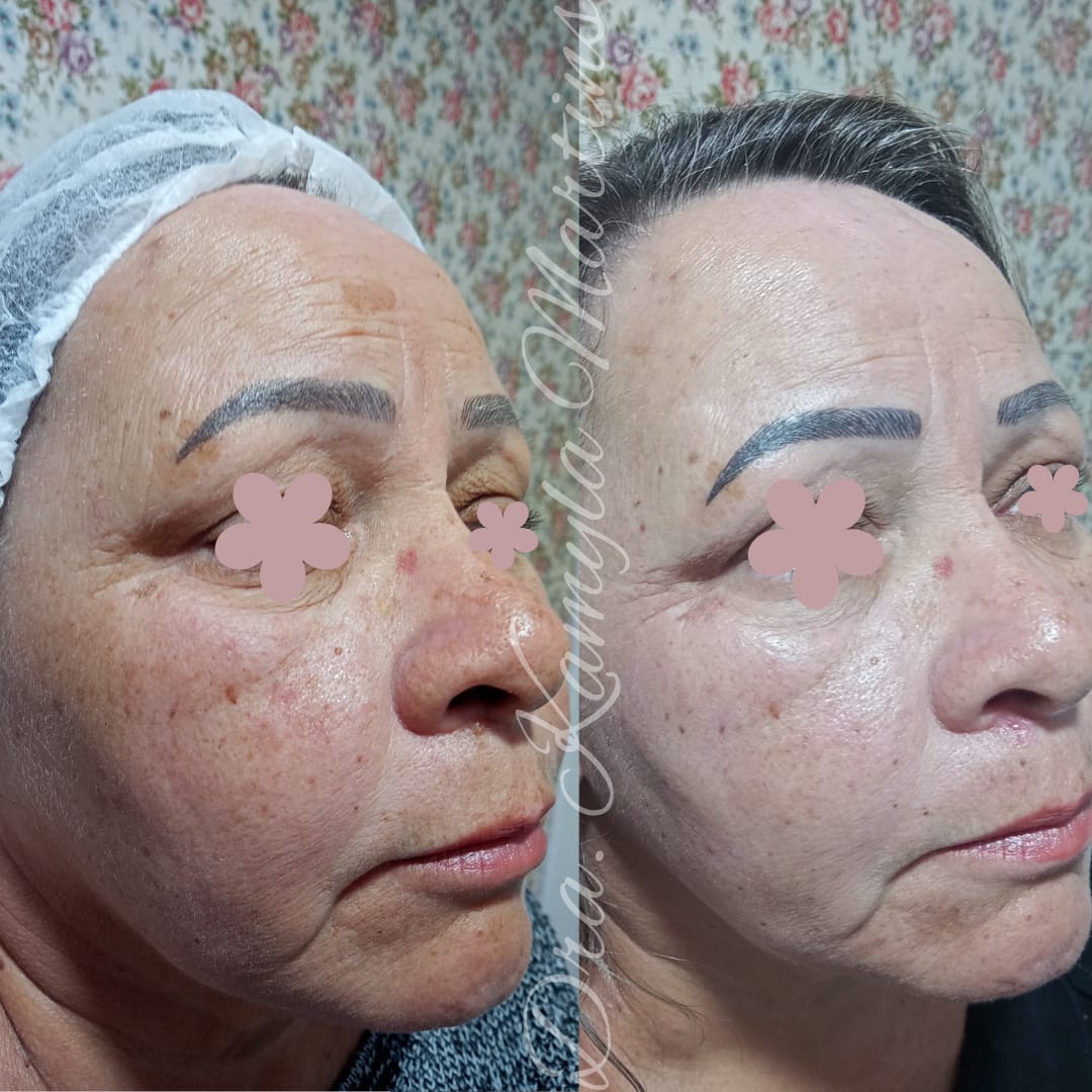 Antes e depois — Peeling químico