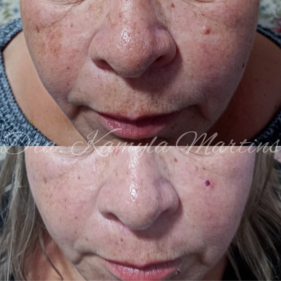Antes e depois — Peeling químico