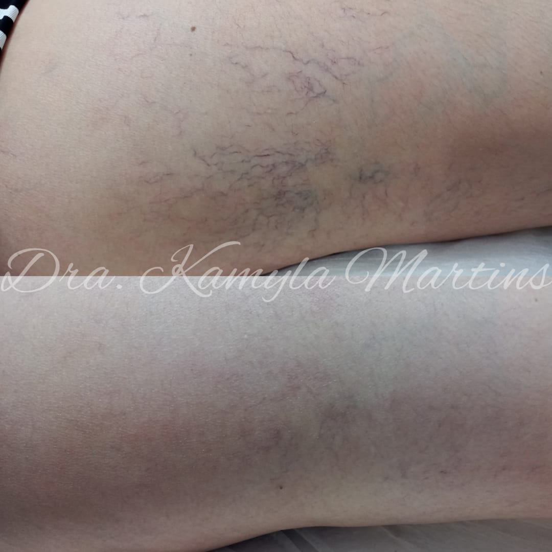 Antes e depois — PEIM