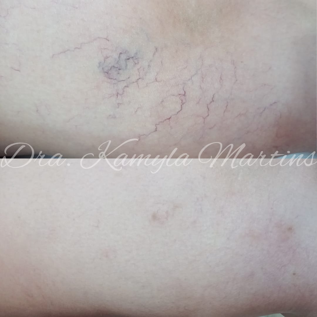 Antes e depois — PEIM