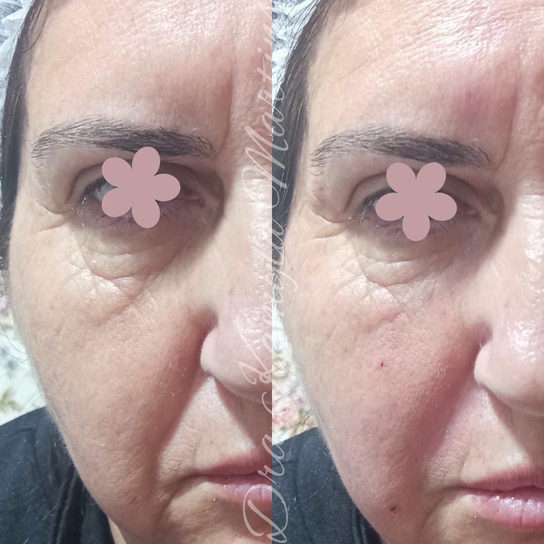 Antes e depois — Calha lacrimal e sulco nasogeniano