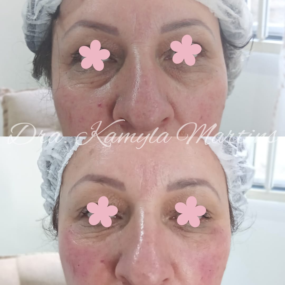 Antes e depois — Calha lacrimal e sulco nasogeniano