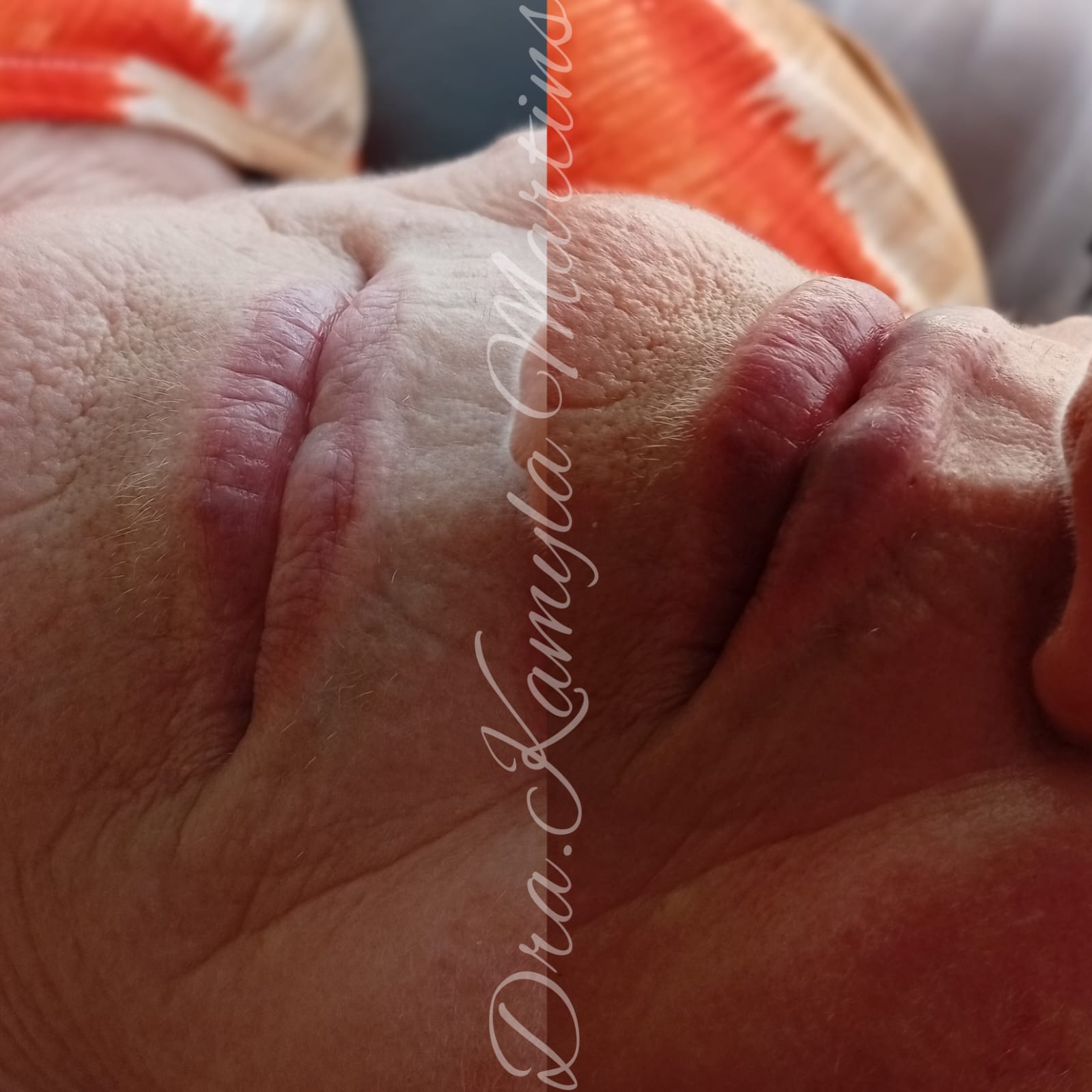 Preenchimento labial