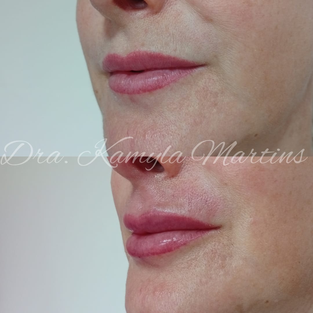 Antes e depois — Preenchimento labial