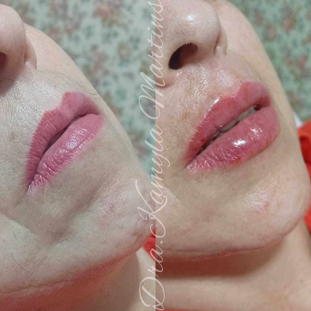 Antes e depois — Preenchimento labial