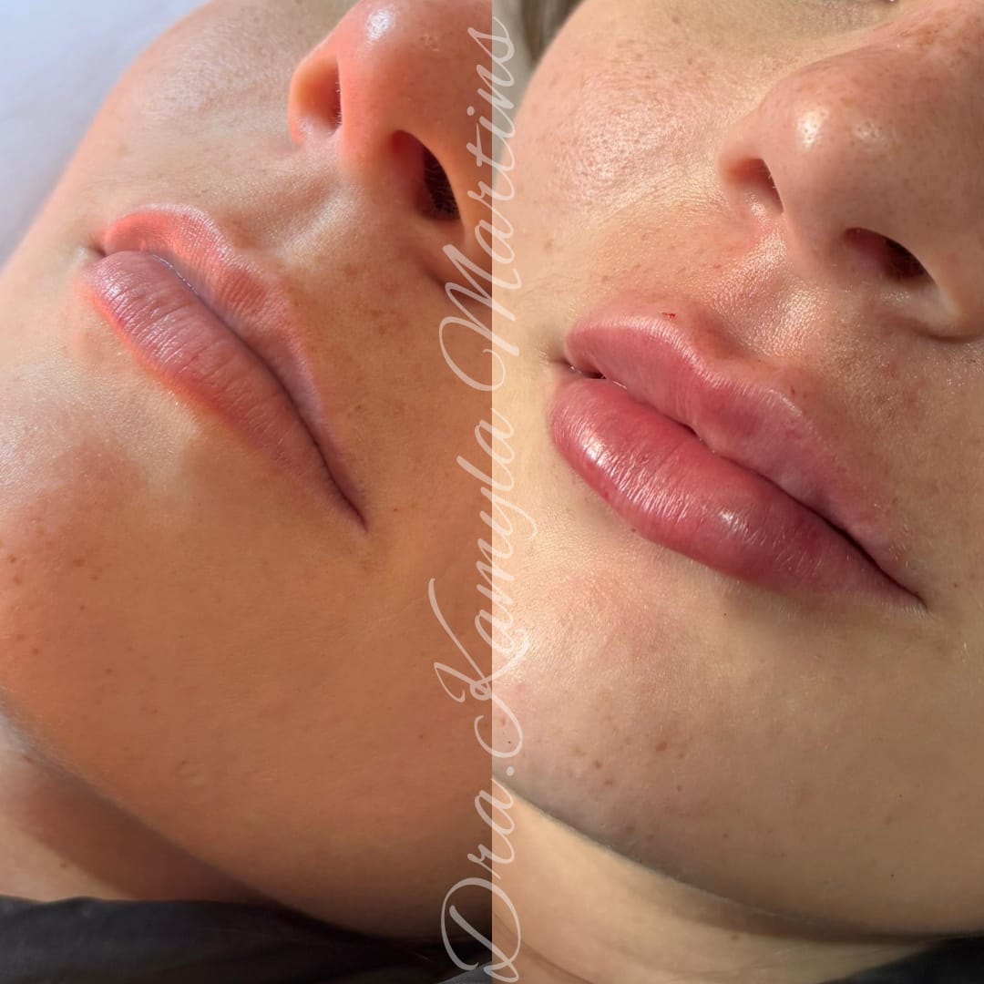 Antes e depois — Preenchimento labial